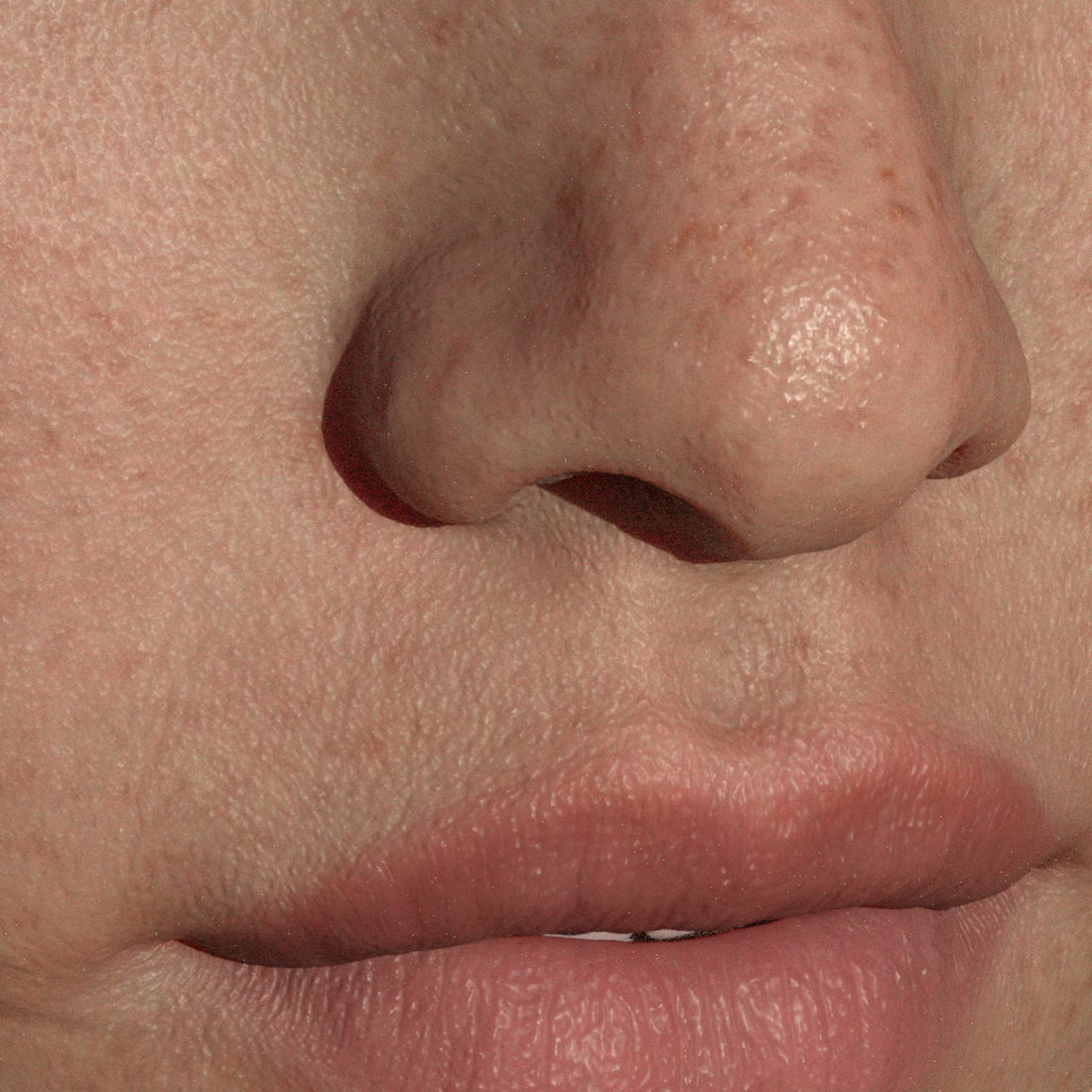 Does Creatine Cause Acne?