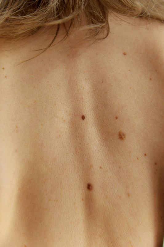 Vitamin D and Acne: A Scientific Perspective