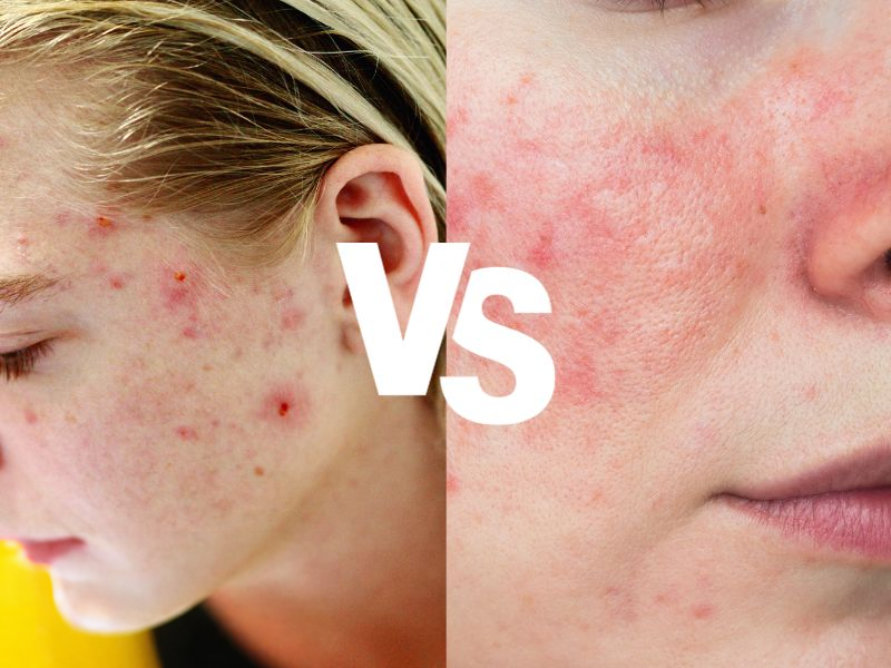 Rosacea vs. Acne: How to Tell the Difference