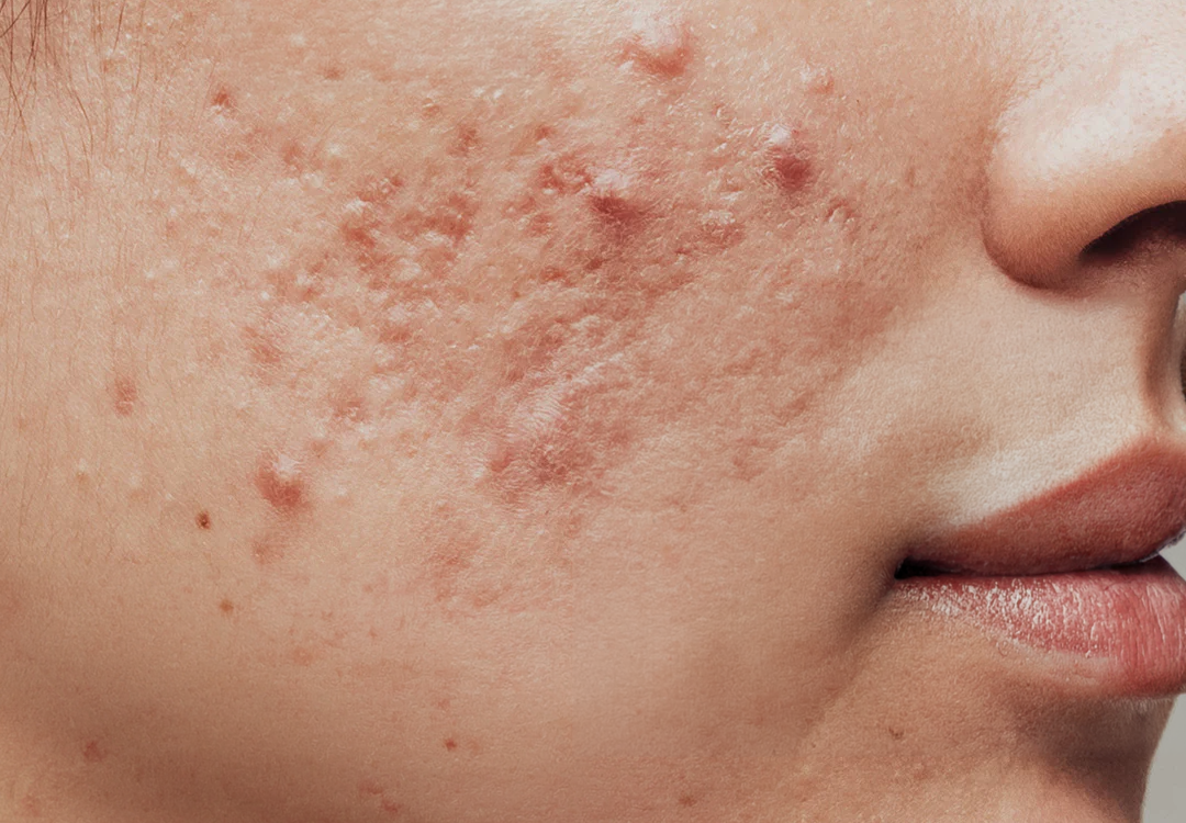 Vitamin D and Acne: A Scientific Perspective